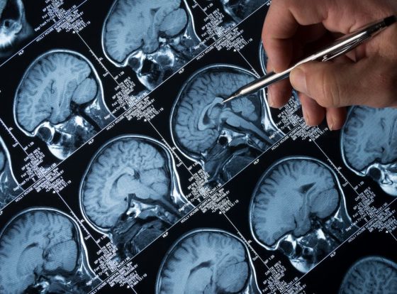 UAE approves use of first and only drug to treat Alzheimer’s