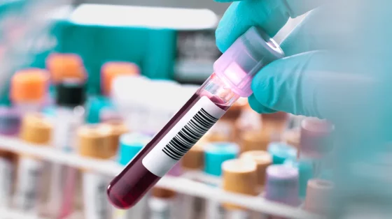 Good News! A Blood Test That Detects Early Stages of Breast Cancer Has Become Available!